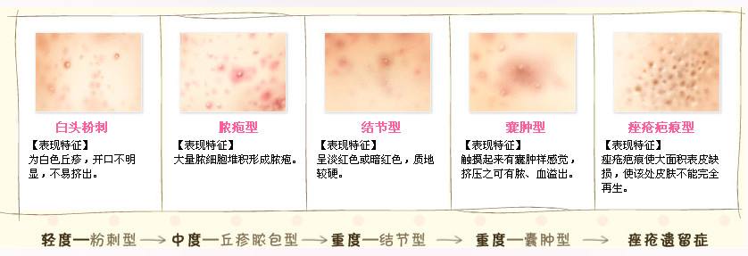 四年痘痘痘坑痘印怎么消除,四年痘痘肌肤改善全过程