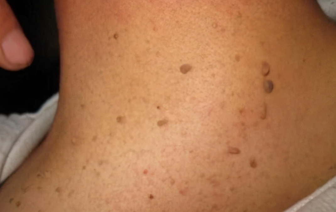 脖子腋下腹股沟长小肉粒怎么去除,腋下脖子上长小肉粒是什么原因