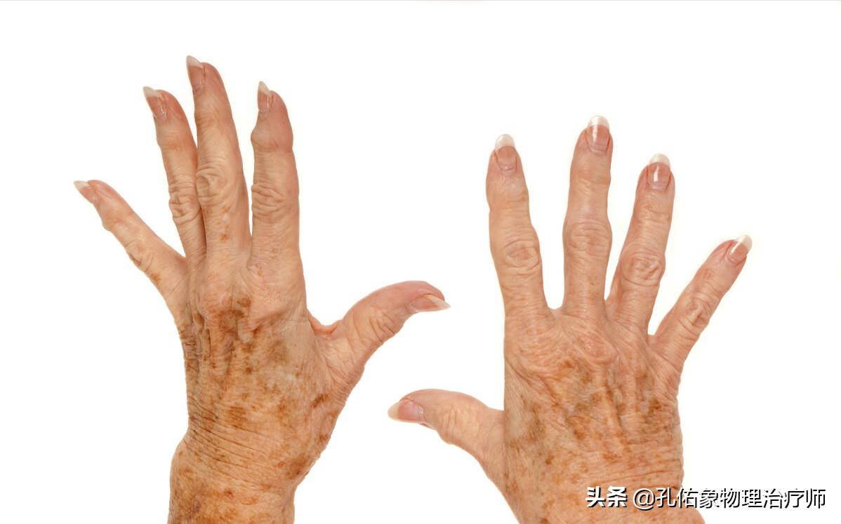 人身上的老年斑怎么去除,年轻人长老年斑消除最好的方法