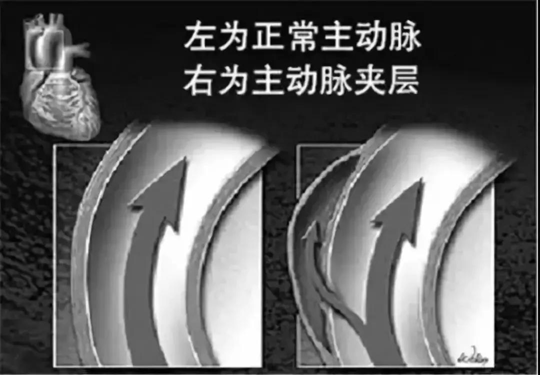 突发胸背疼20分钟后好了,半夜胸背痛是什么病的先兆