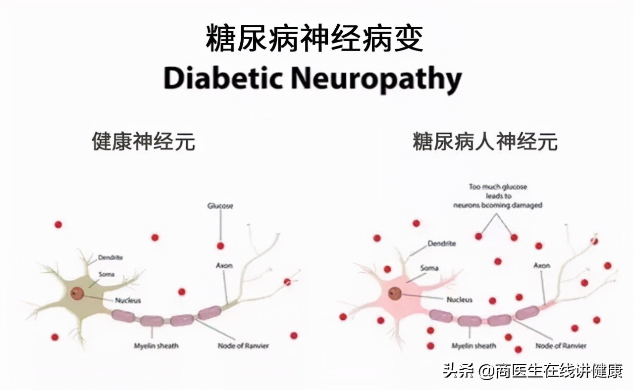 糖尿病神经病变吃甲钴胺能痊愈吗,糖尿病神经周围病变吃甲钴胺多久