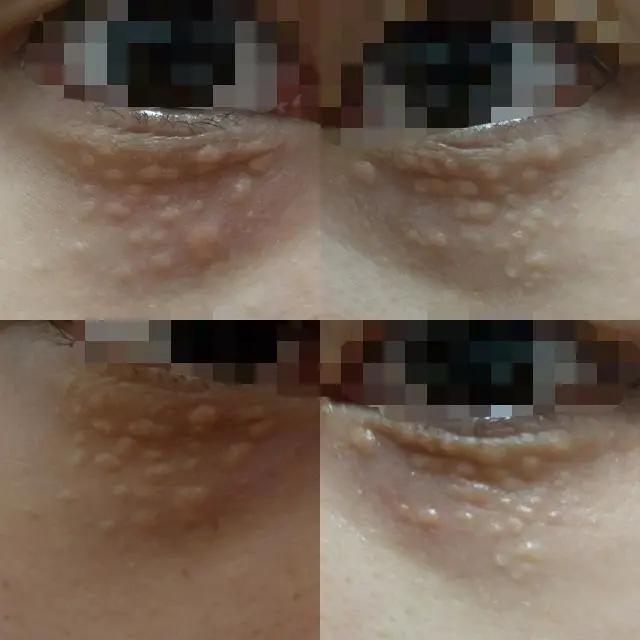 你长得真的是脂肪粒吗？如何解决“脂肪粒”？