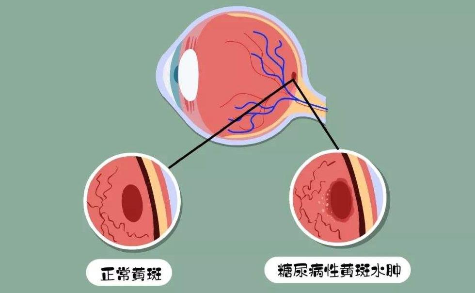 好消息关于医保,眼底病手术费进医保吗