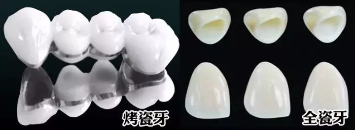 蛀牙了十几年还需要做根管治疗吗,蛀牙了一个小洞要根管治疗吗