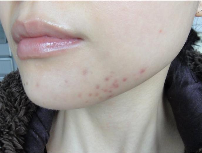 教你4个淡化黑色痘印的有效方法,改善痘印用什么酸效果最好