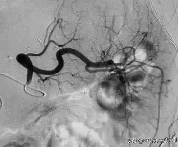 治疗房颤的安全高效方法,房颤窦性停搏安装起搏器指征