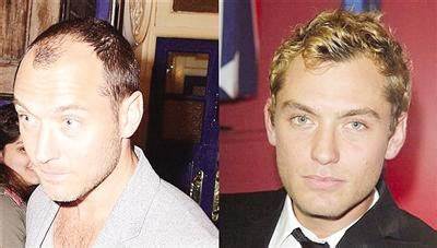 为什么英国人头越来越秃,英国谢顶