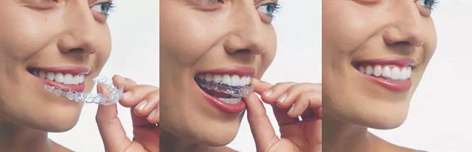 牙齿矫正黑幕素材,牙齿正畸内幕