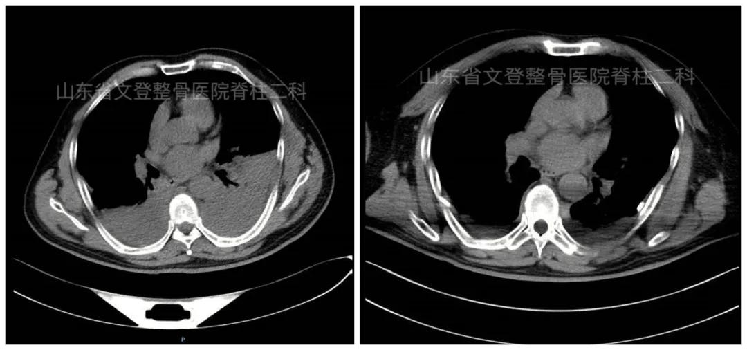 文登整骨医院治疗截瘫,山东文登整骨医院治疗怎么样
