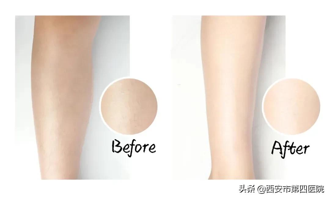 #安心变美课堂##我的安心变美推荐#夏日脱毛还也能美白！？