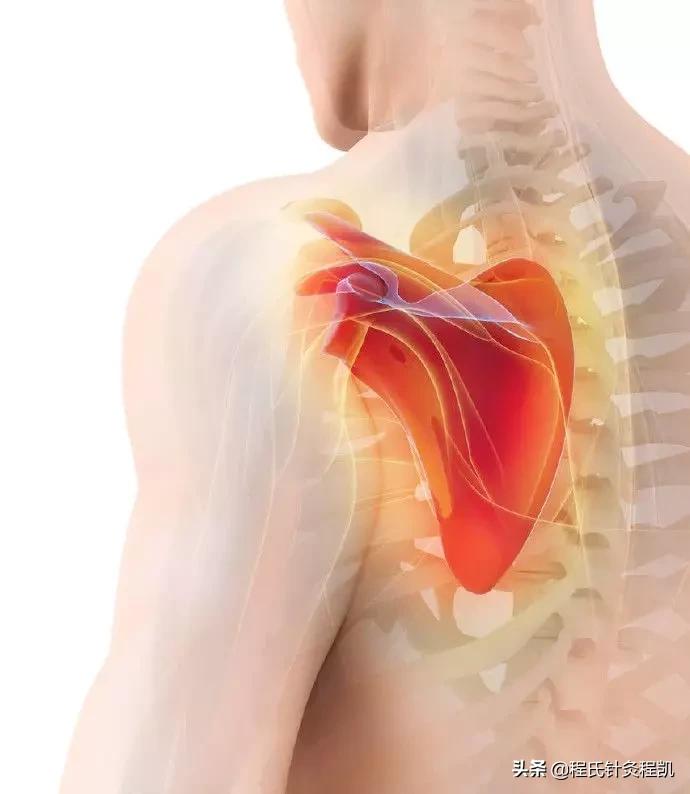 肩胛骨弹响是怎么形成的如何改善,肩胛骨弹响综合症的症状