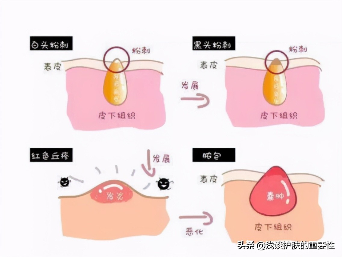 脸上痘痘多应该用什么护肤品,痘痘肌有痘印的正确护肤方法