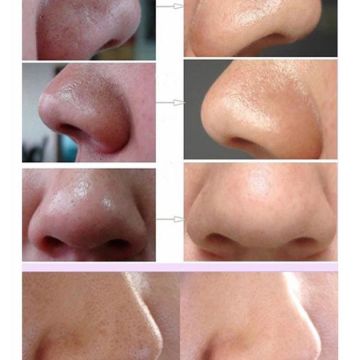 用牙膏清理鼻子上的黑头,用牙膏怎么去黑头小技巧