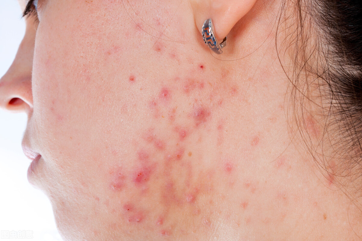 玫瑰痤疮反复发作怎么治疗,痤疮常见皮损不包括