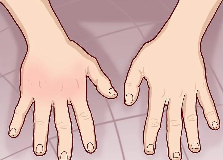 手骨折反复疼痛怎么办,手痛了一个月是骨折吗