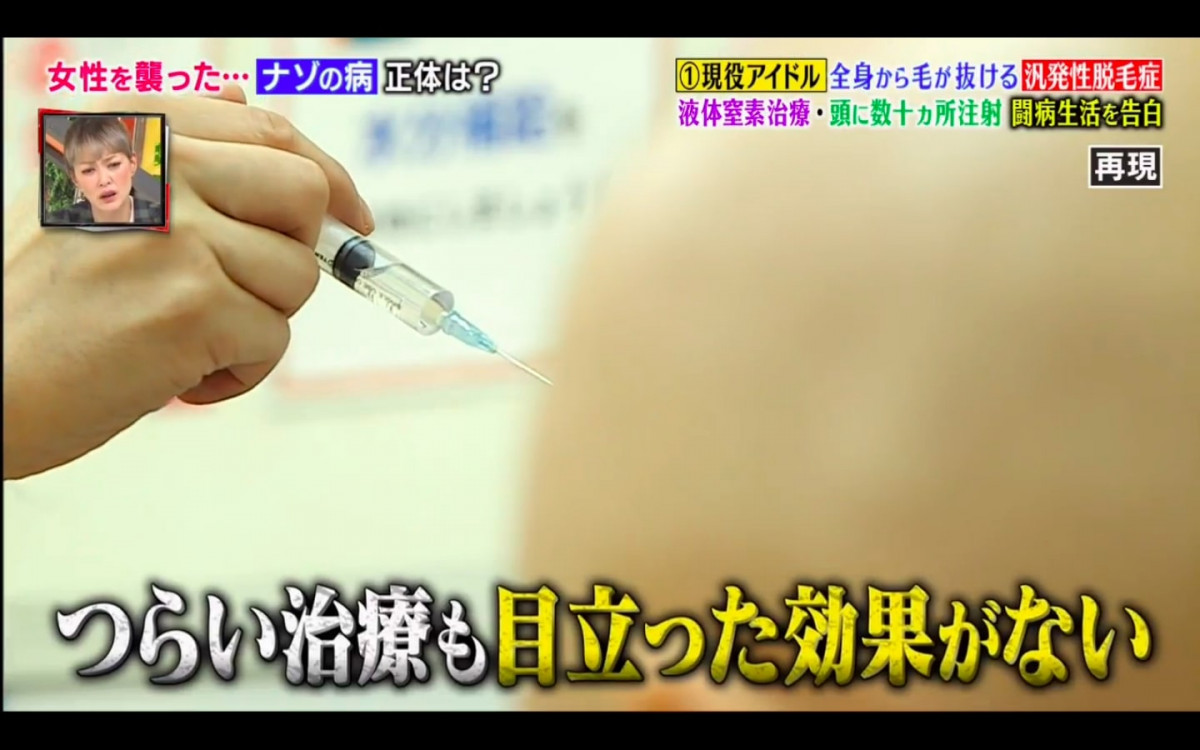 日本15岁脱毛症状,日本脱毛症