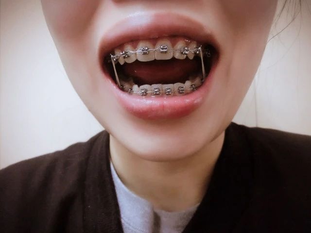 拔牙矫正牙齿后口腔溃疡怎么办,矫正牙齿后经常口腔溃疡怎么办