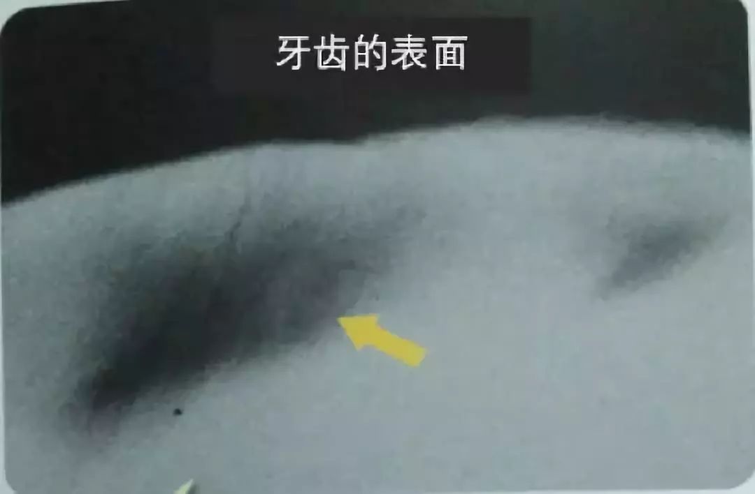 牙齿脱矿白斑怎么修复,牙医修复牙齿漏洞蛀牙全过程