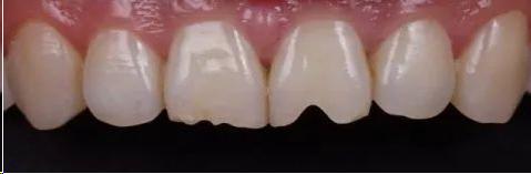 长期嗑瓜子形成瓜子牙可以修复吗,嗑瓜子把牙磕豁了怎么办