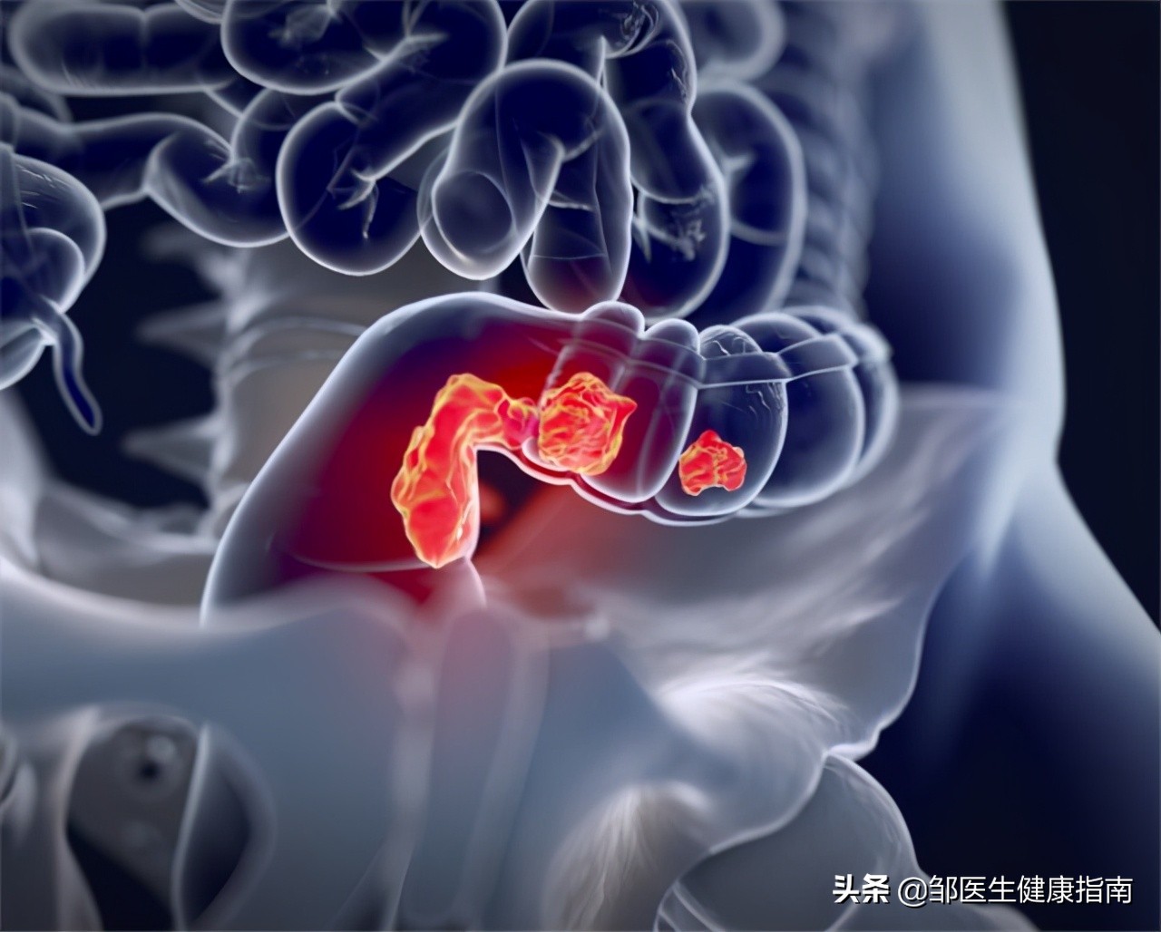 28岁小伙直肠癌晚期,23岁小伙直肠癌