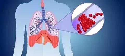 肺动脉栓塞的抢救视频,肺动脉主干栓塞