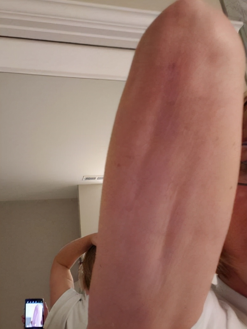 抽脂减肥成了植物人,整形抽脂死亡