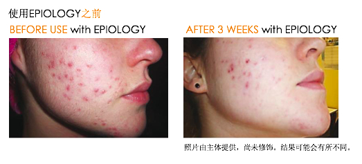 “新西兰牛奶”做出来的祛痘修护产品有多神？