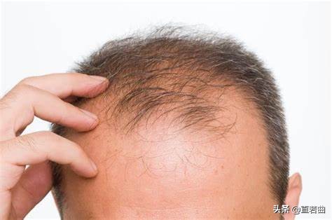 免疫力攻击毛囊导致斑秃,雄性脱发怎么造成的