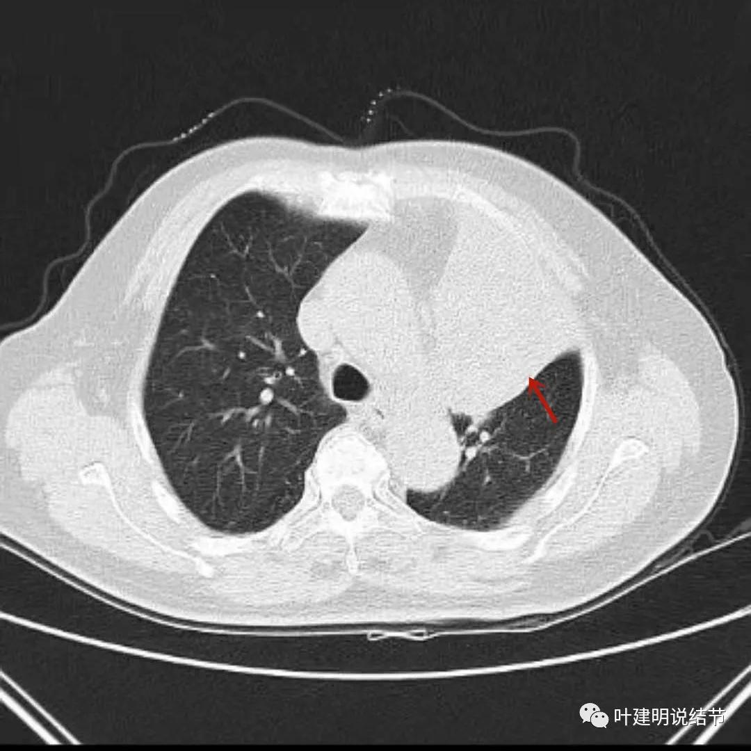 高龄肺癌靶向治疗效果,高龄老人肺癌早期适合放疗吗