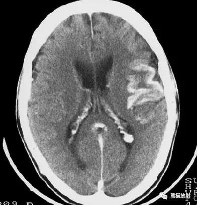 脑梗死丨演变、血供区域分布、CT表现