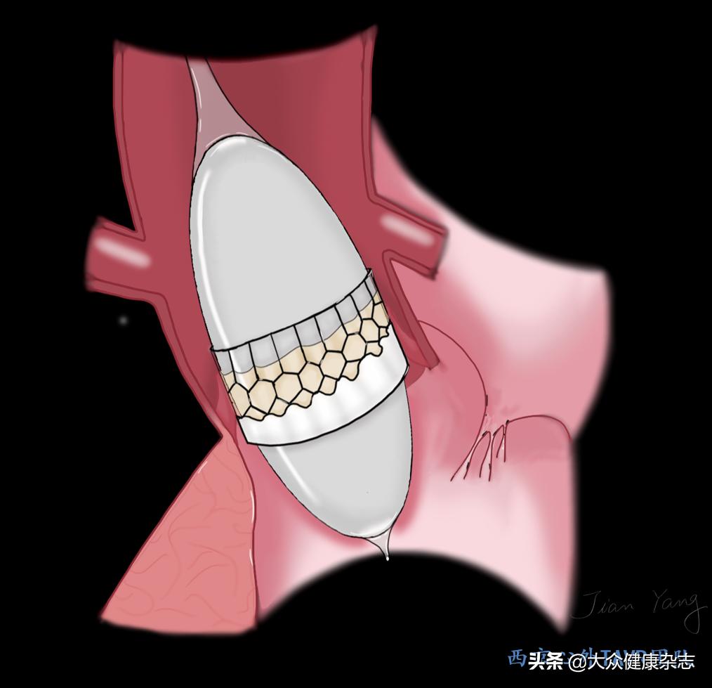 球囊扩张主动脉瓣膜,心脏球囊扩张瓣膜