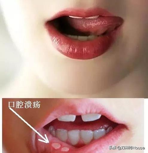 口腔溃疡去门诊用什么药,口腔溃疡去医院挂号