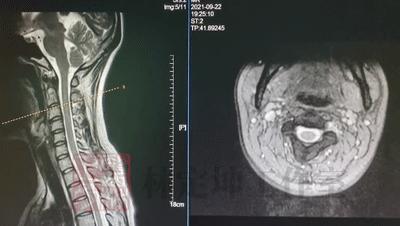 颈椎病的六种分型及专科检查,正骨治颈椎病需要几次