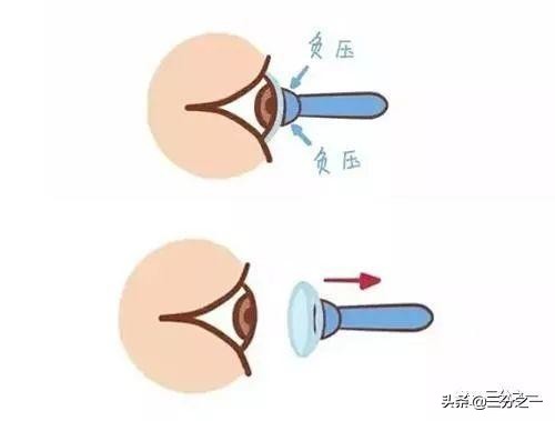 关于OK镜——家长们，为什么总是第一时间就问“孩子自己能…吗”