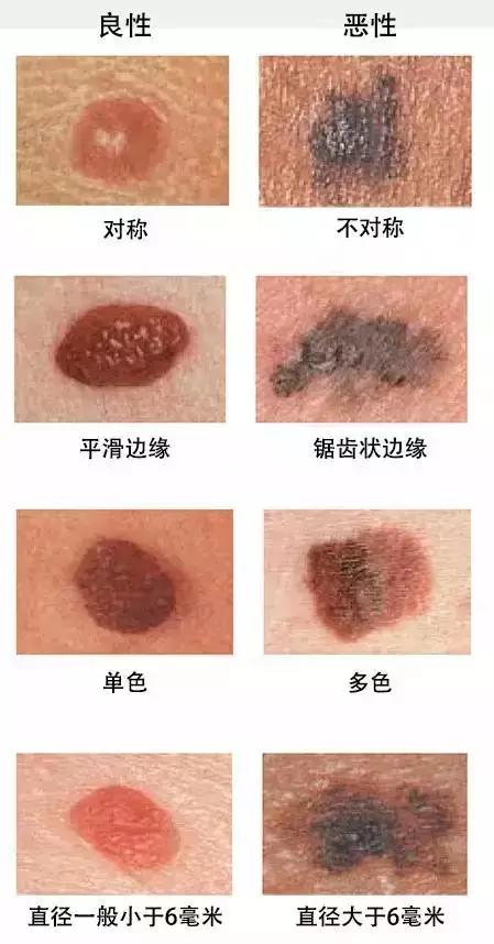 点痣最好是去什么机构,在广州点痣去什么机构点好