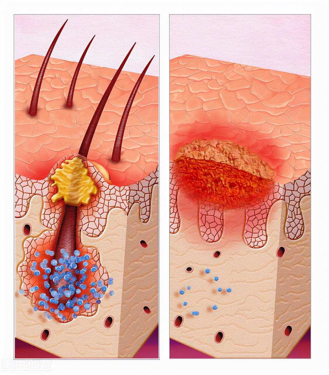 头皮上凸起一个硬疙瘩抠了又长,头皮长疙瘩抠了反复结痂怎么治
