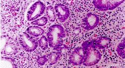 慢性萎缩性胃炎c2期可怕吗,再谈萎缩性胃炎的治疗步骤