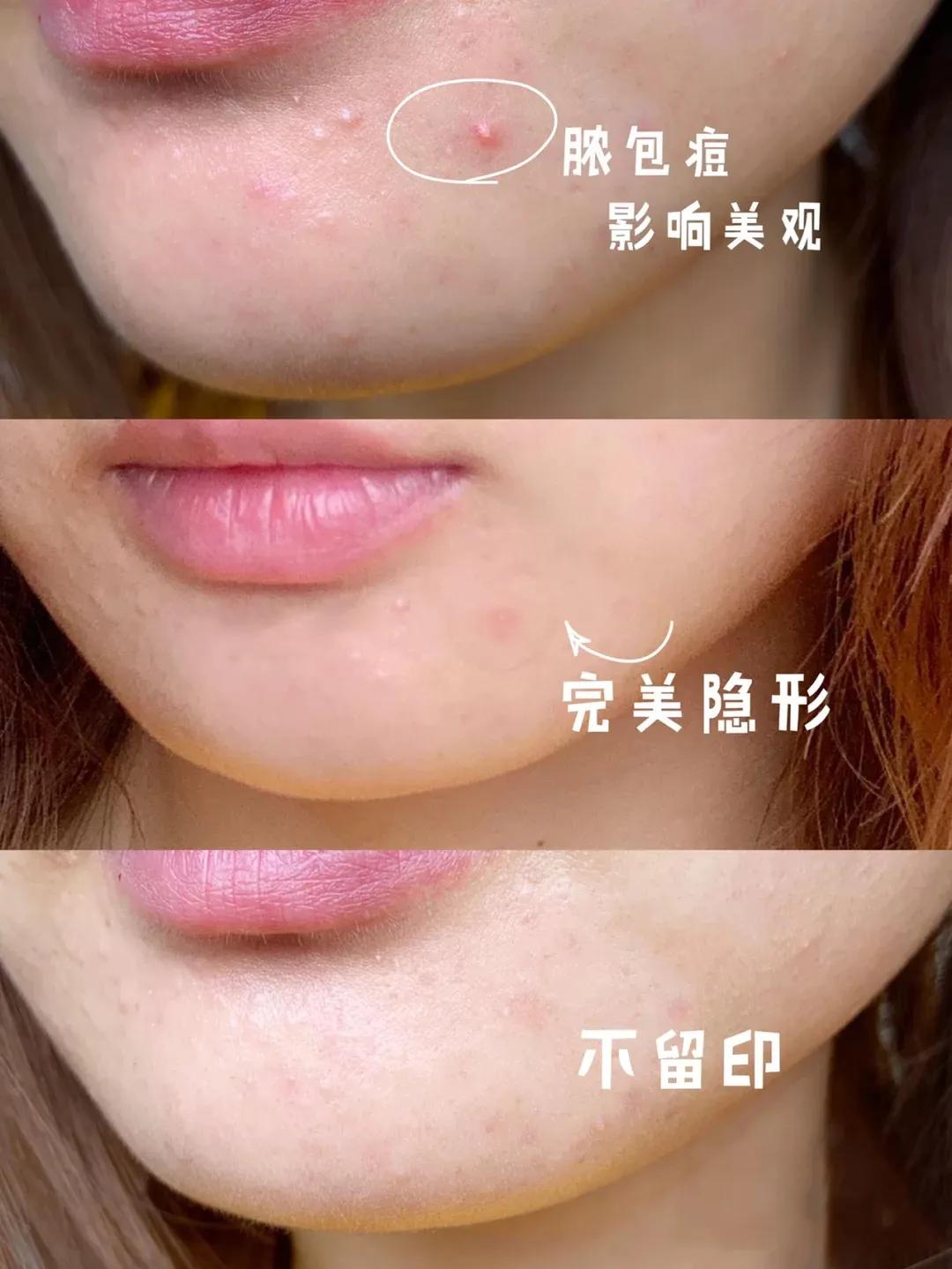 李佳琦推荐的痘痘贴,李佳琦推荐痘痘贴面膜