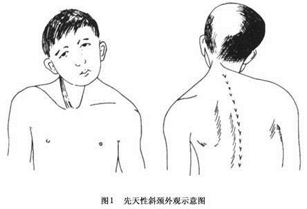 宝宝脖子歪了怎么判断斜颈,婴儿脖子斜颈和骨头歪怎么办