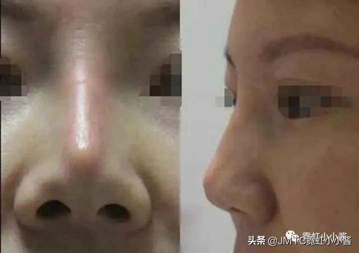 鼻子怎么修复好看呢,鼻型修复方法大全