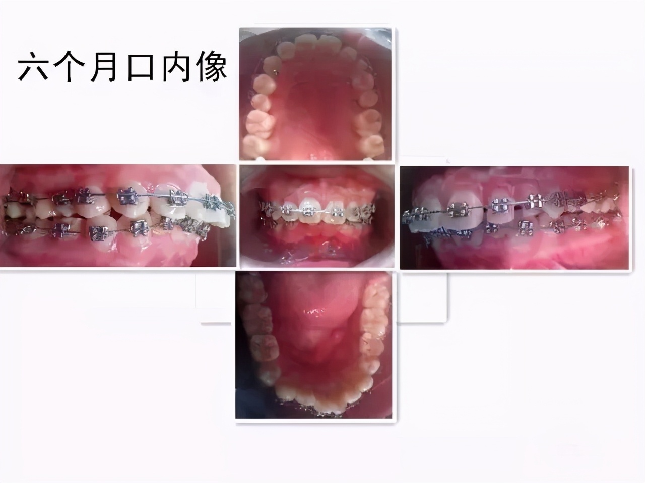 成年人牙齿矫正戴上牙套嘴巴变凸,扩弓会使脸型变大吗