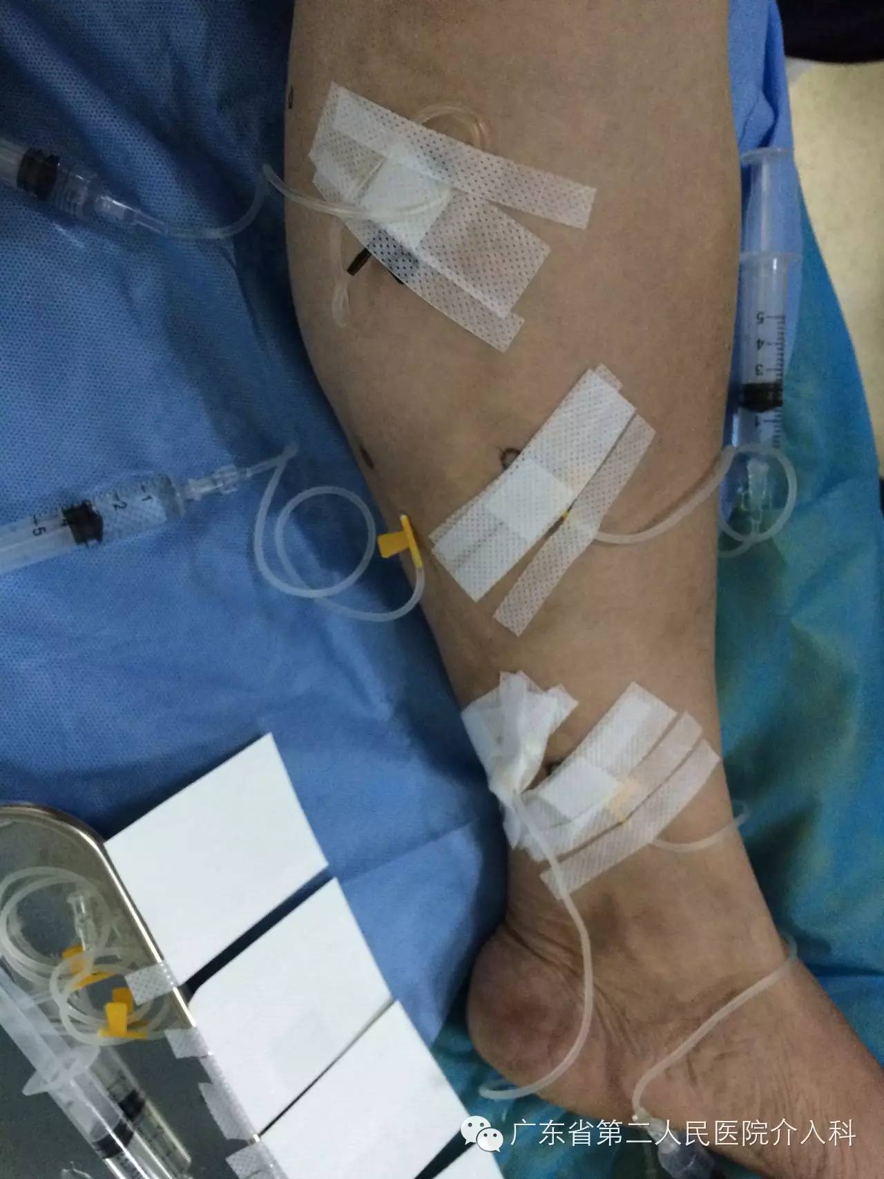 静脉曲张硬化治疗广泛应用…细针解决老难题，难看的蚯蚓腿不见了