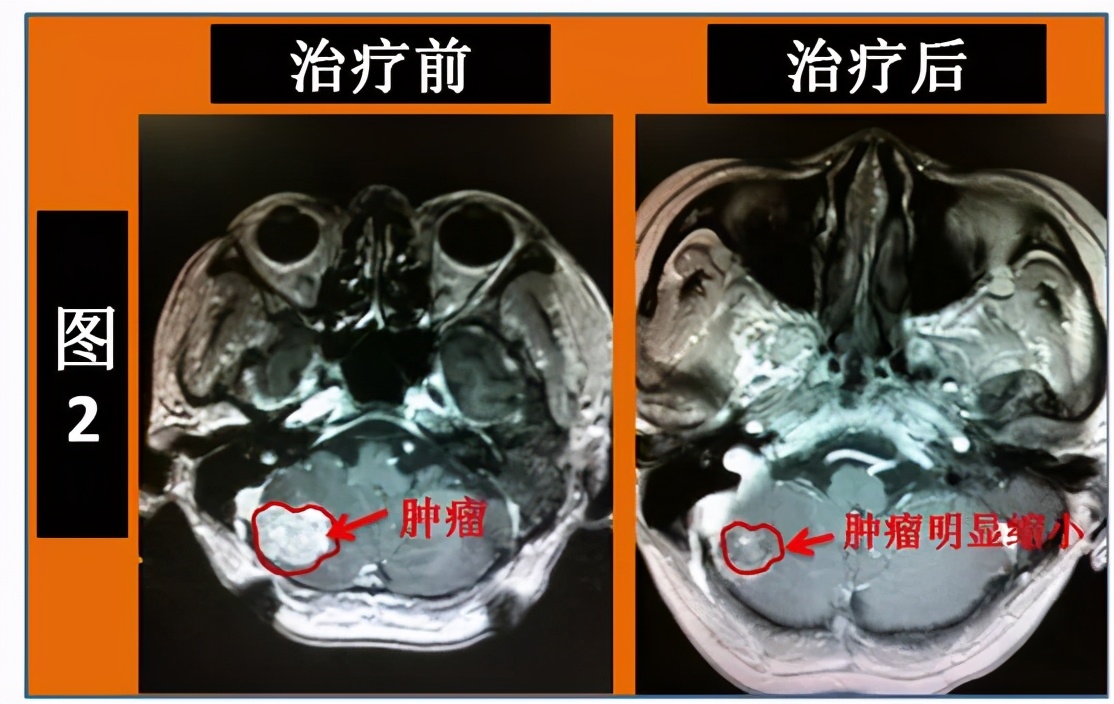 伽玛刀治疗疾病的优点,伽玛刀治疗什么病