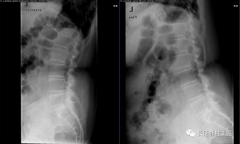 老年人腰椎管狭窄可以微创手术吗,老年人腰椎管狭窄瘫痪