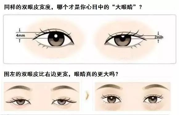 我想做个双眼皮,上睑下垂做了提肌双眼皮