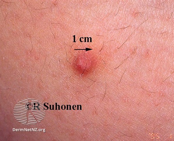 皮肤表面有个深褐色很硬的肿块？别担心，可能是皮肤纤维瘤