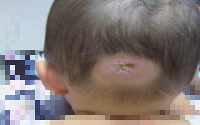 眼角内长的血管瘤破了怎样止血,头皮血管瘤破了止不住血怎么办