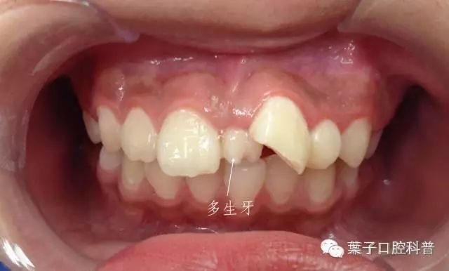 4岁小孩儿牙缝大正常吗,小朋友牙缝大正常吗