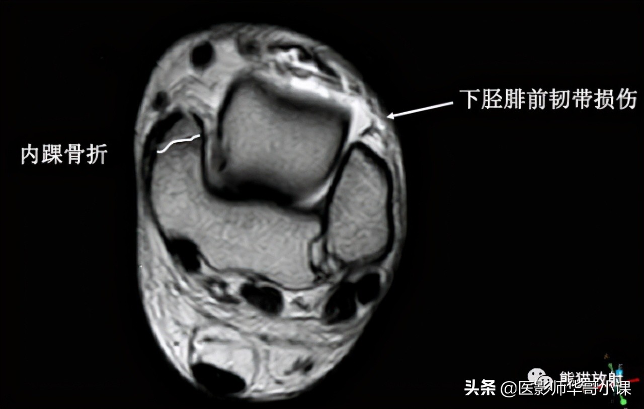 踝关节解剖视频课,解剖学韧带分布图
