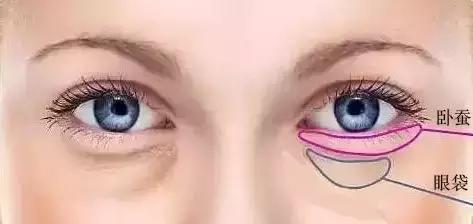 去眼袋要卧蚕两种技能全get,去眼袋需要什么条件